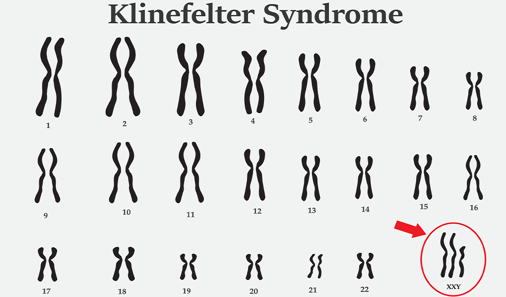 Klinefelter Syndrome In Female
