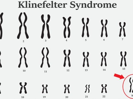 Klinefelter Sendromu Nedir, Tipleri Nelerdir?