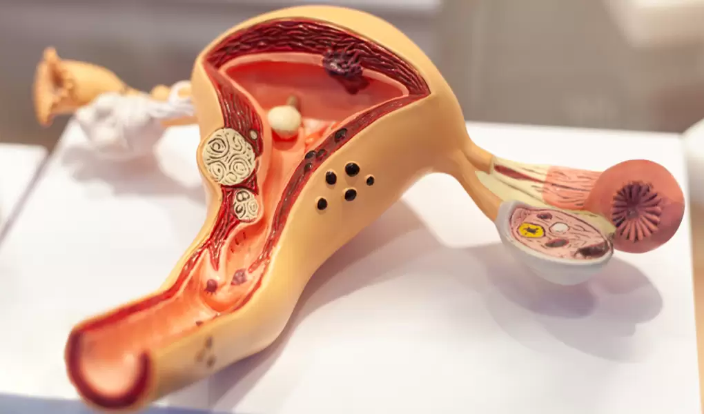 What is Uterine (Endometrium) Cancer and What are the Symptoms of Uterine (Endometrium) Cancer?