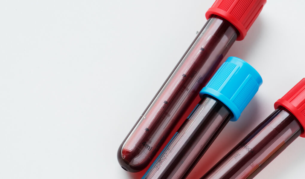 Kan Uyuşmazlığı Testi (İndirekt Coombs) Nedir?