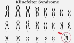 What Is Klinefelter Syndrome? Types, Symptoms, Diagnosis and Treatment