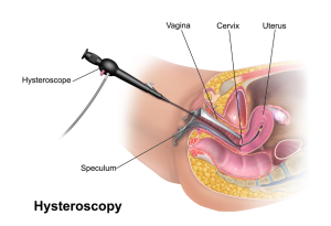 Хистероскопията - какво представлява и как да се подготвим?