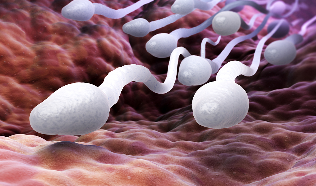 Mikro Tese Ameliyatında Sperm Çıkmazsa Ne Olur?